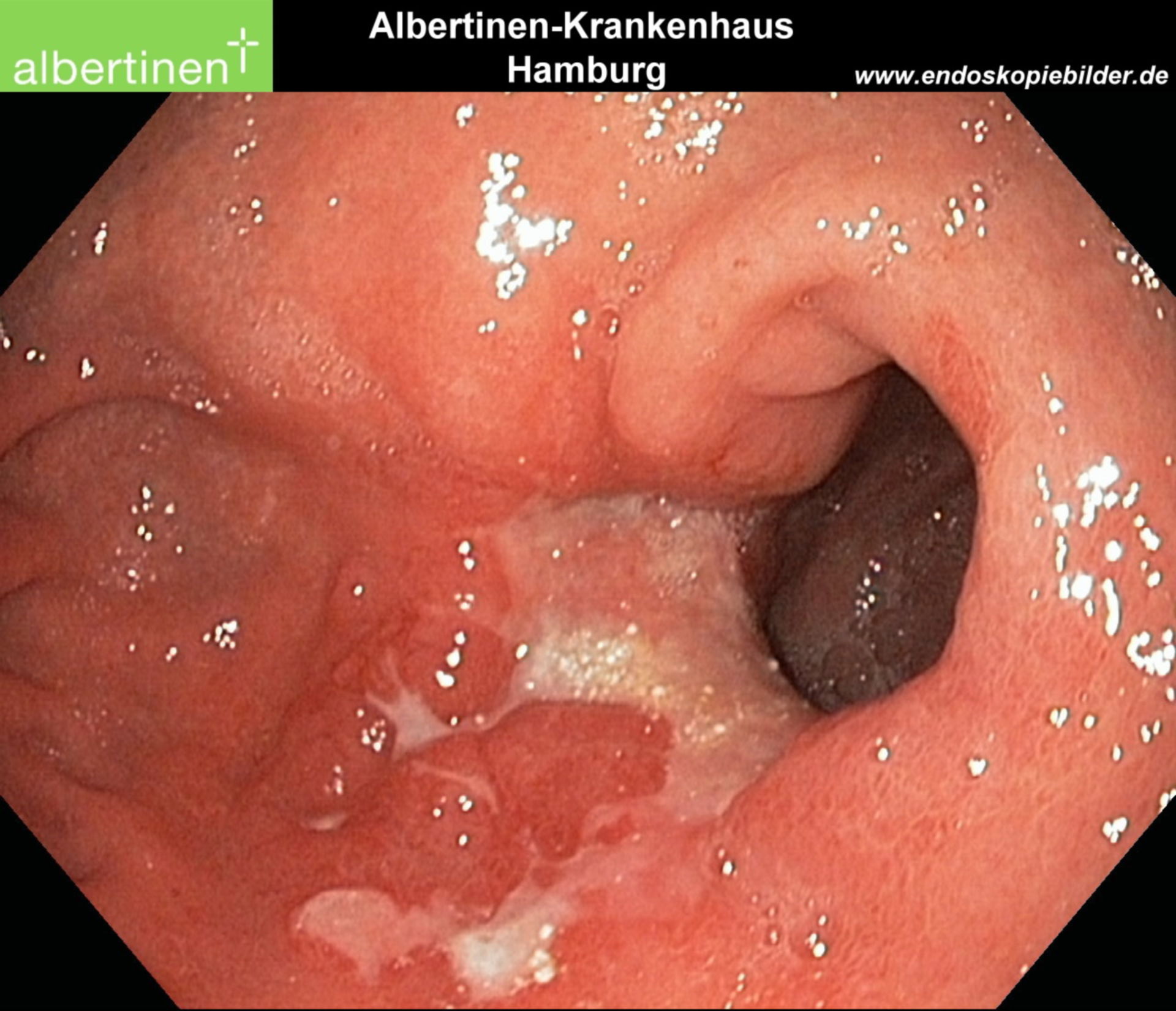 Endoscopia: carcinoma gastrico ulceroso