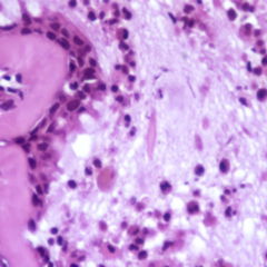 CharcotFuß DocCheck Flexikon