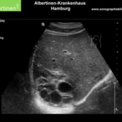 Follikuläre Zyste DocCheck Flexikon