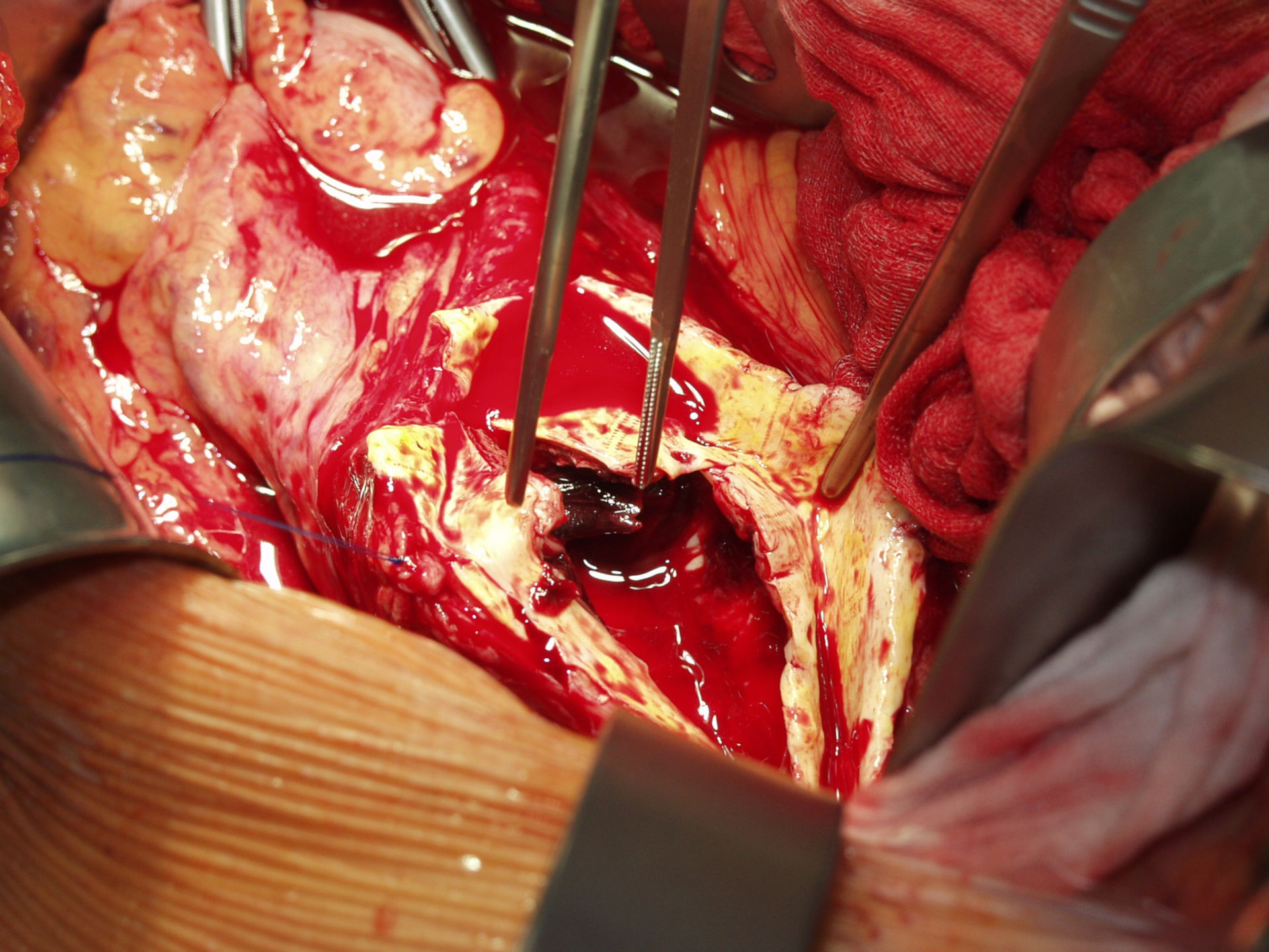 Aneurisma de aorta (2c)