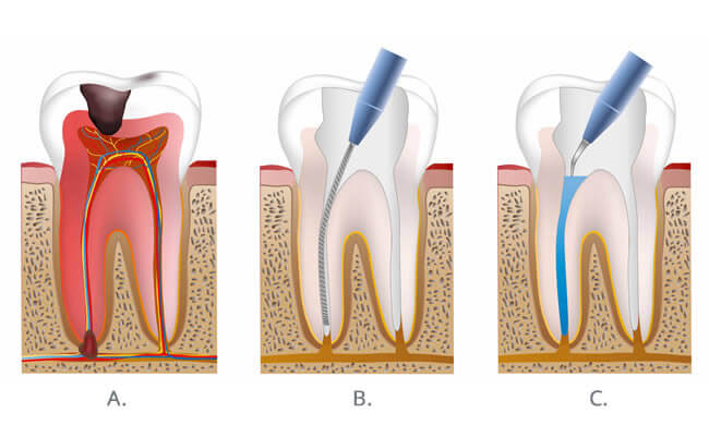 everything_you_should_know_about_root_canal_procedure__1__original.jpg