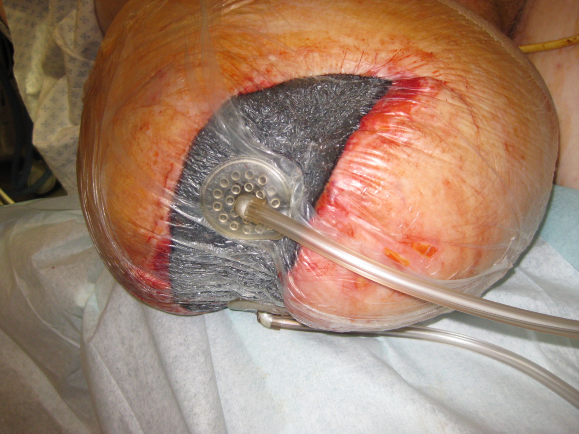 VAC treatment of an infection of the right thigh stump