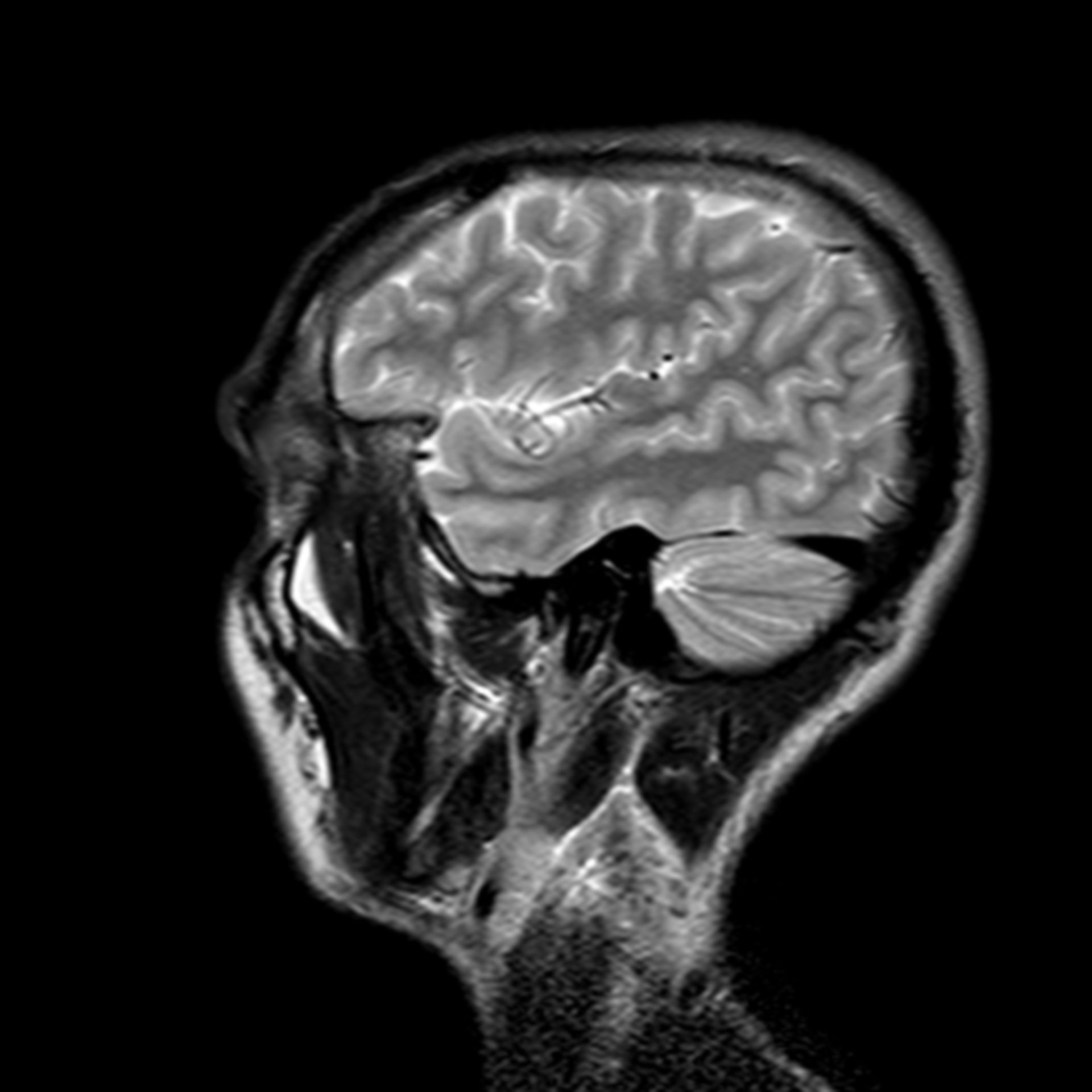 (27/34) MRT Schädel in Sagittalebene, T₂‐gewichtet