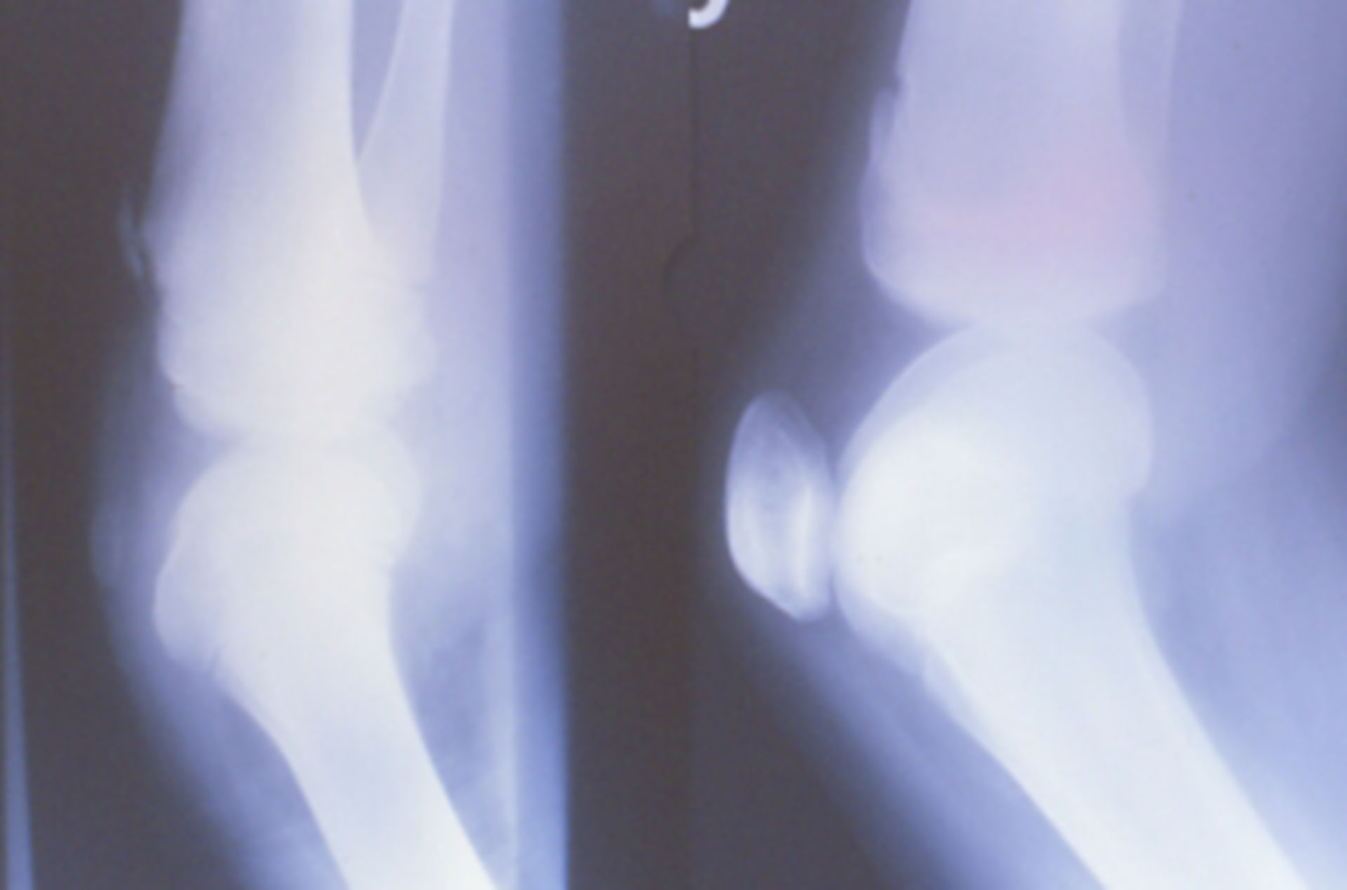 Radiological characteristics of the knee joint in nail patella syndrome