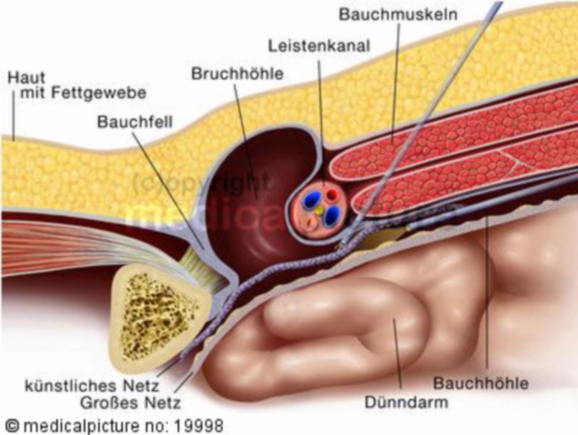  Leistenbruch, minimalinvasive Operation, inguinal hernia, minimal invasive surgery 
