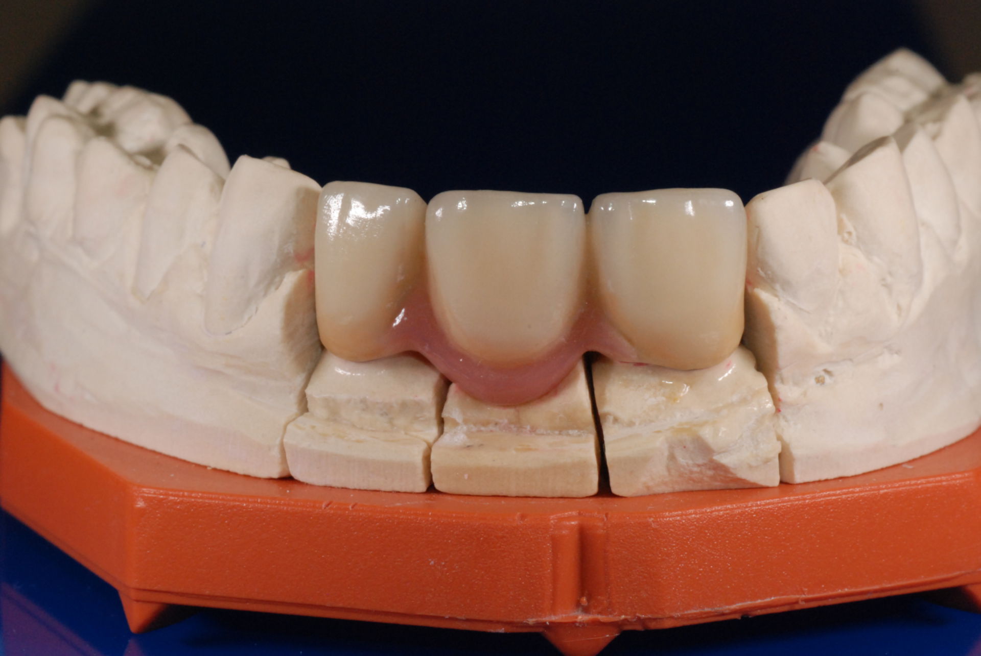 Ceramic dental bridge