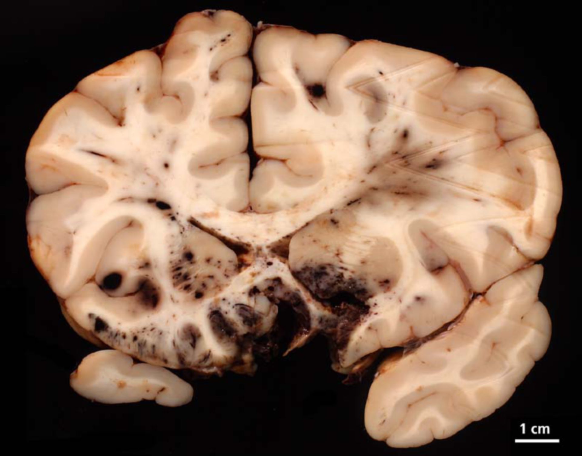 Lesioni cranio cerebrali con contusione emorragica