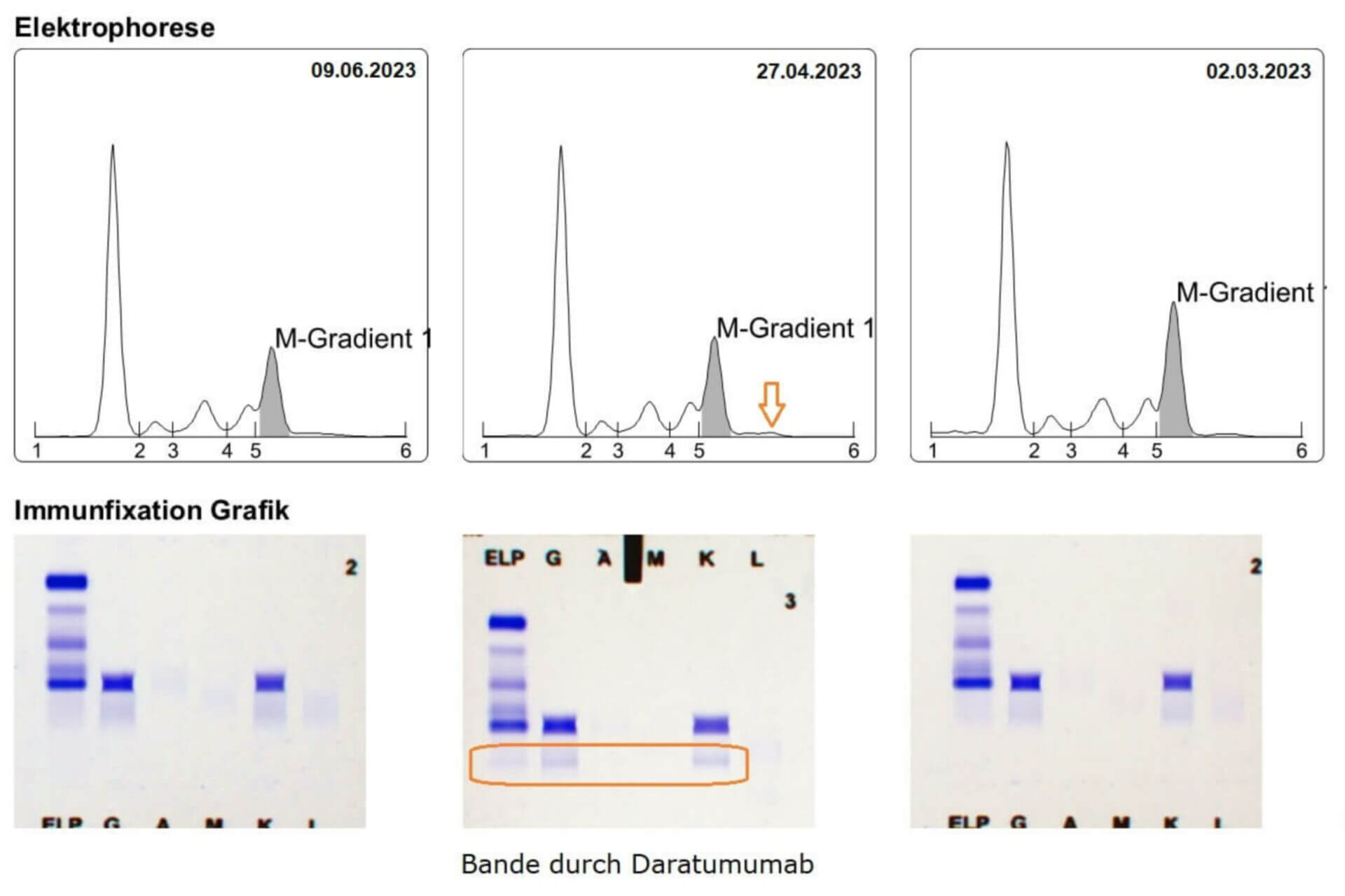 Monoklonaler Antikörper Daratumumab in der Immunfixation