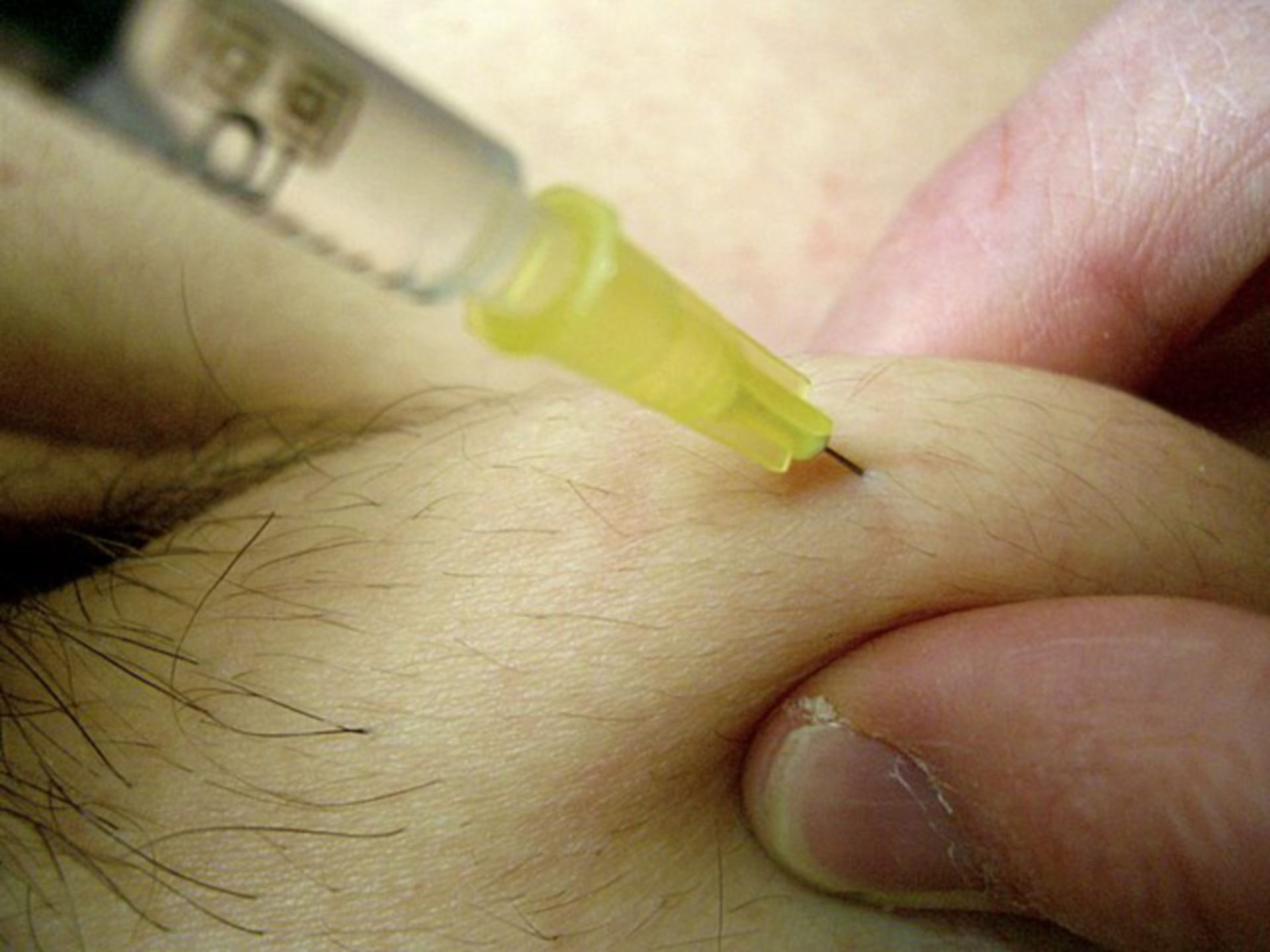 subcutaneous injection