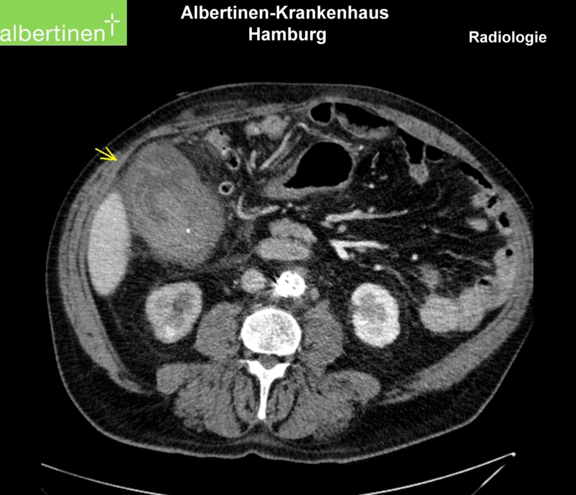 CT Cholezystitis Pfeil