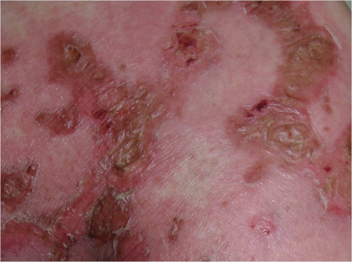Erythema necrolyticum migrans (ENM)