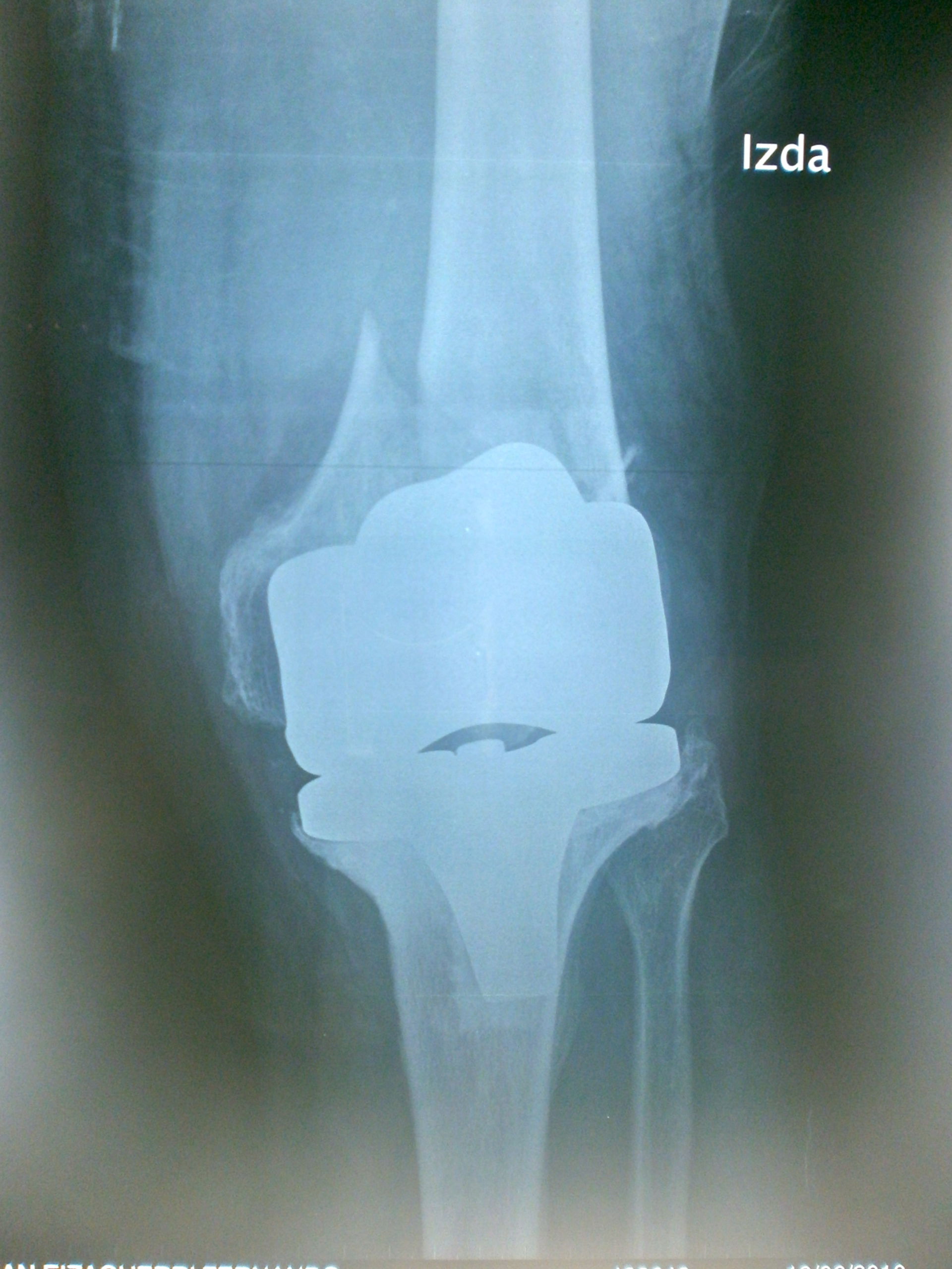 periprosthetic fracture knee