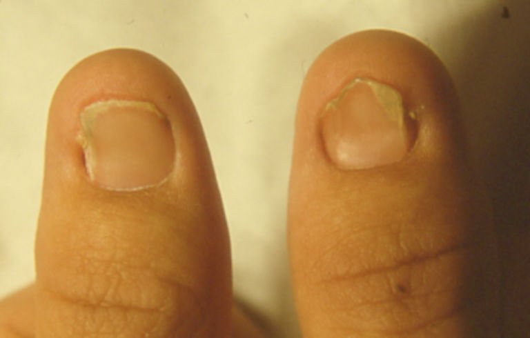 Achondroplasia and nail-patella syndrome: the compound phenotype | Journal  of Medical Genetics