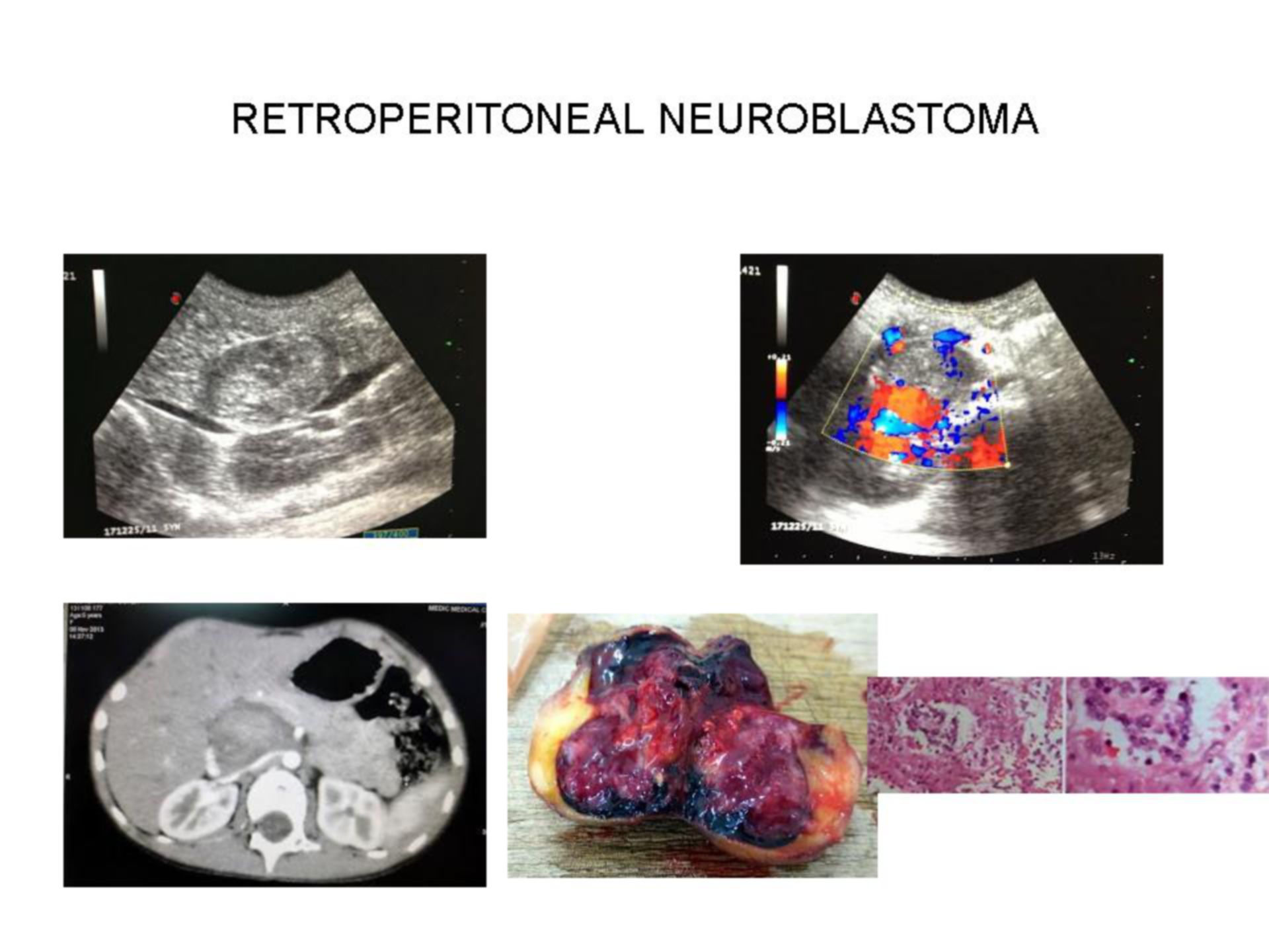 Neuroblastoma retroperitoneal