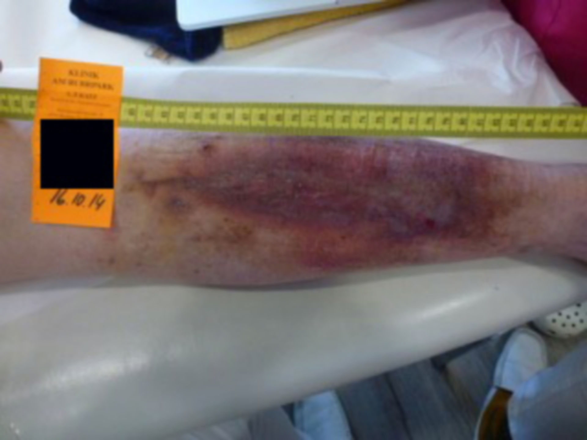 Ulcer of the lower leg- open for 20 years: one day before discharge (16)