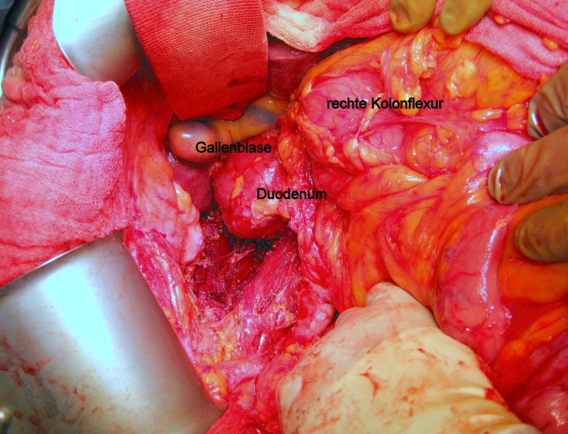 Leiomiosarcoma ricorrente sulla destra - outcome postoperatorio dopo resezione