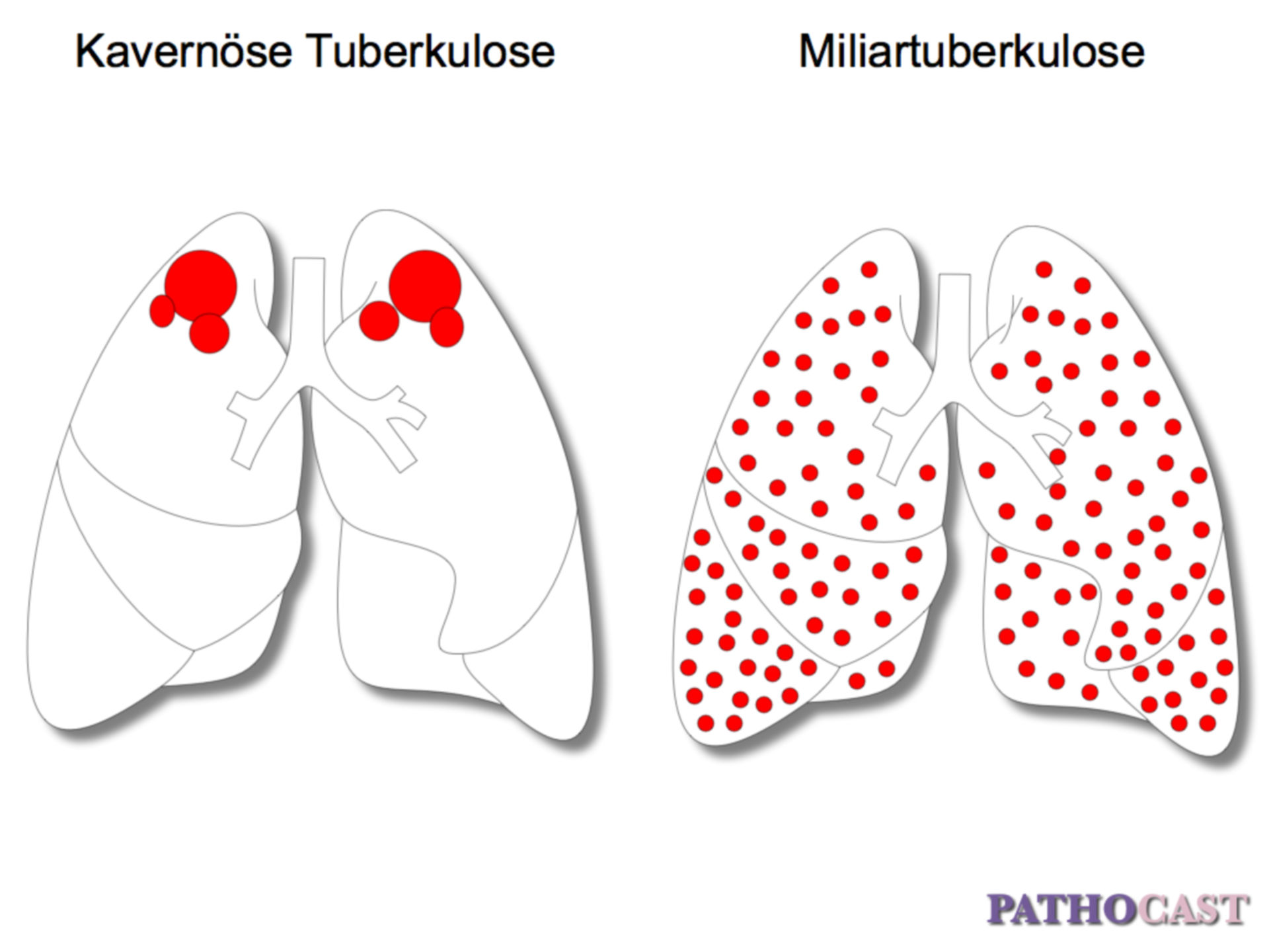Caverna vs tubercolosi miliare