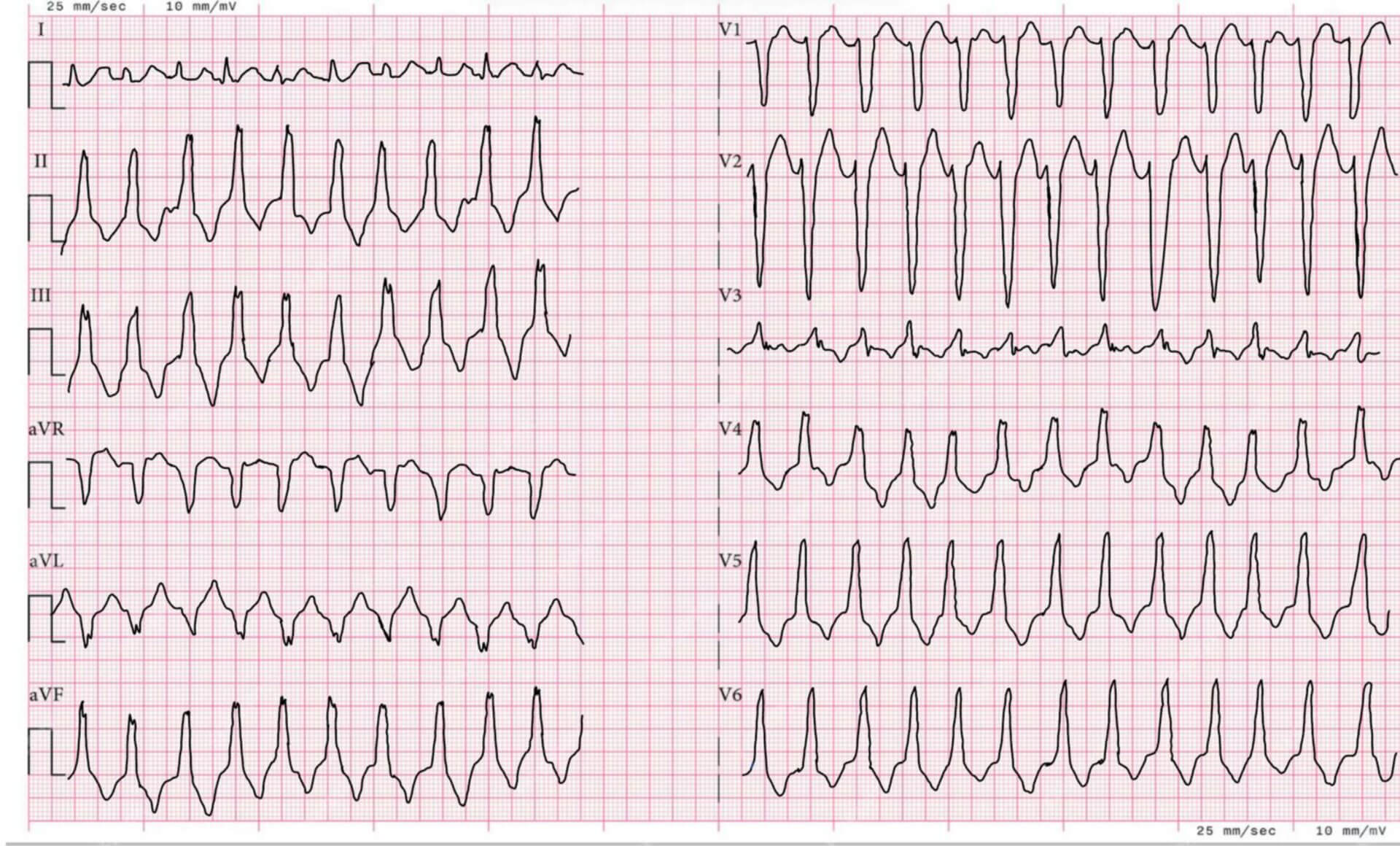 Rechtsventrikuläre Ausflusstrakttachykardie