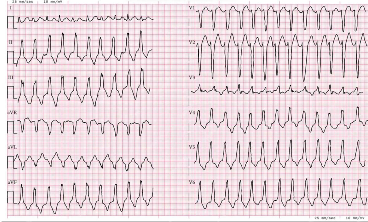 Rechtsventrikuläre Ausflusstrakttachykardie