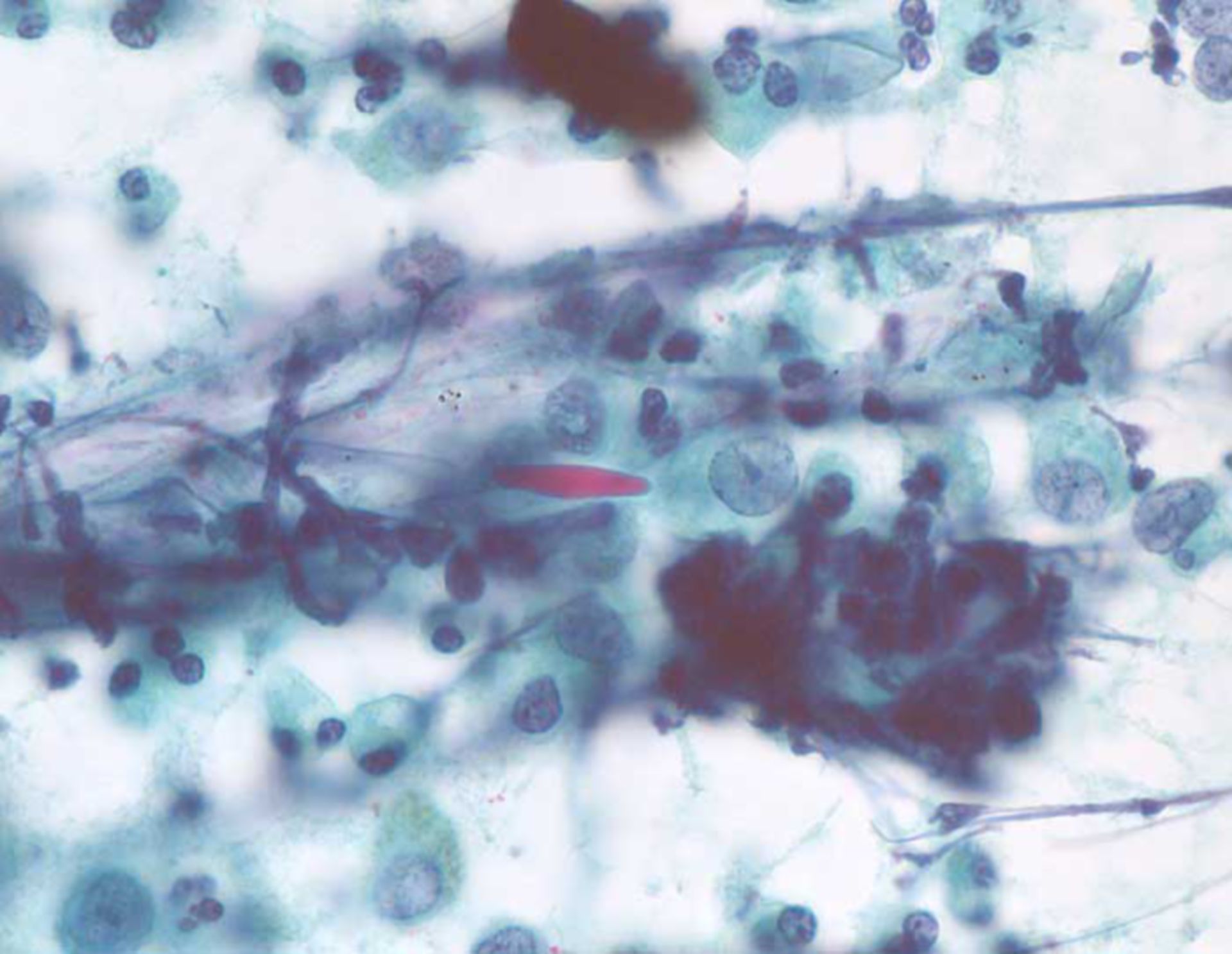 Eosinophilia in the setting of Churg-Strauss vasculitis: Charcot-Leyden crystal