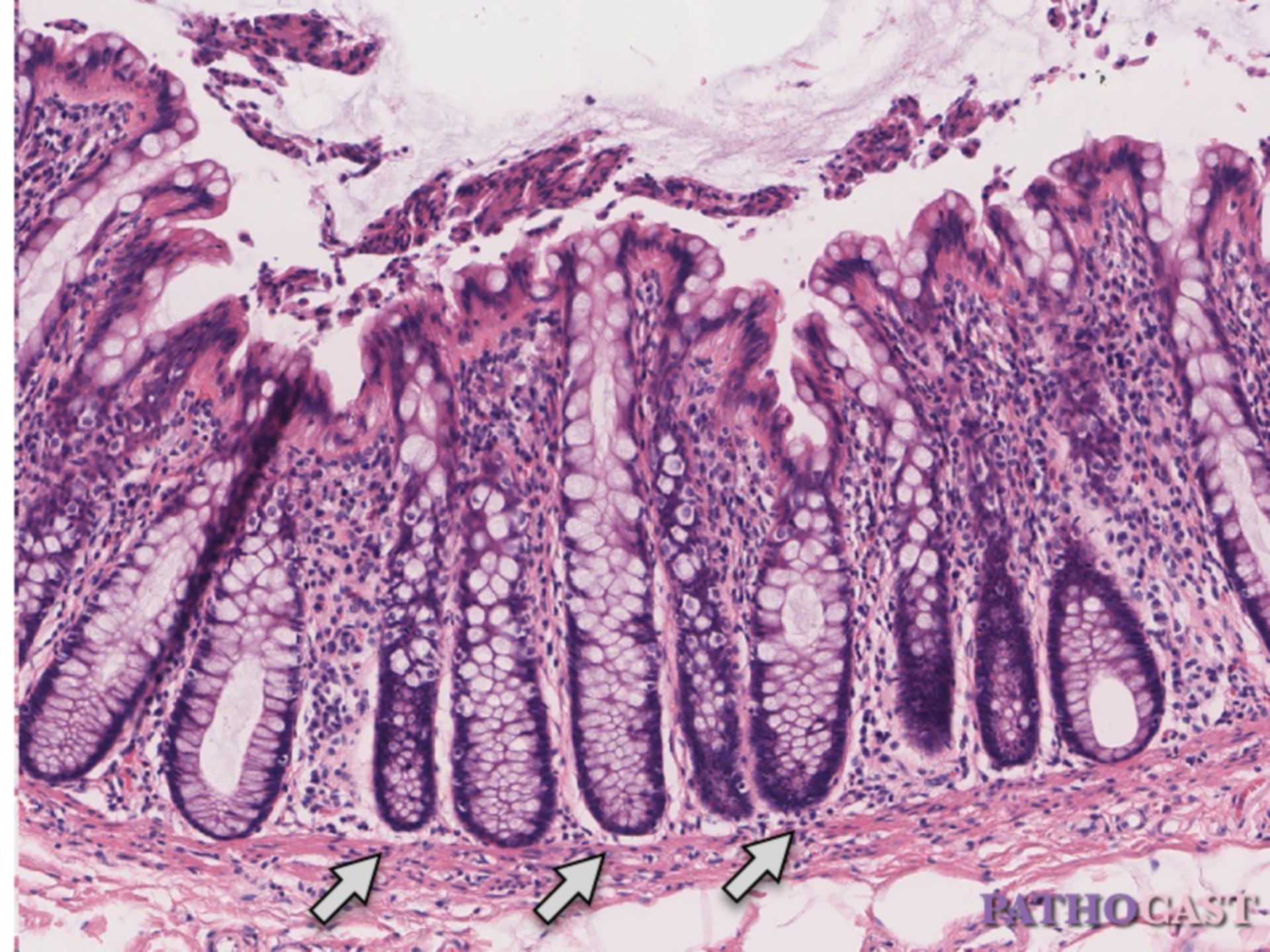 Mucosa del colon senza risultati patologici