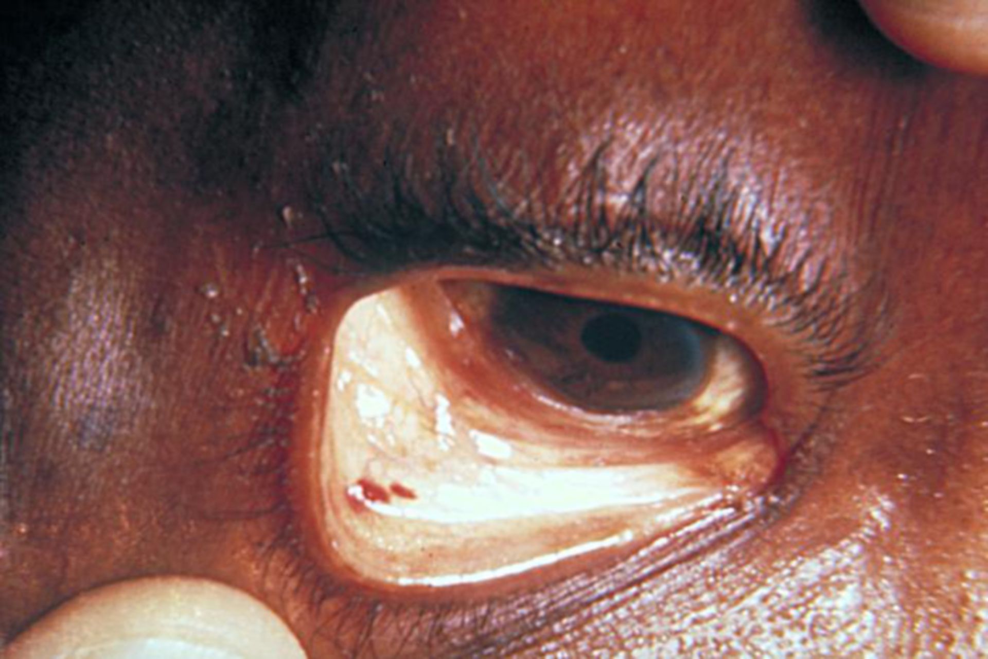 Staphylokokken-Infektion: Sepsis - Auge
