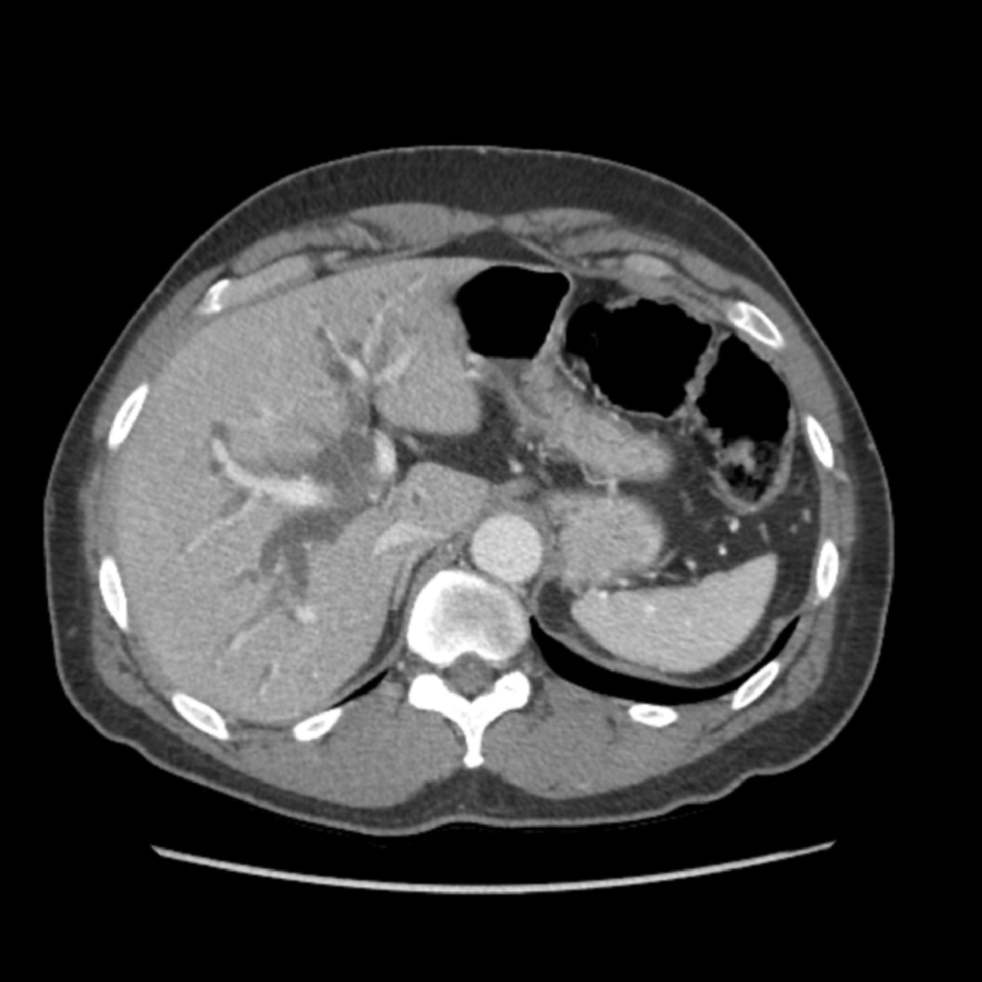 CT Bild zeigt erweiterte Gallengänge in der Leber aufgrund eines Klatskin Tumors