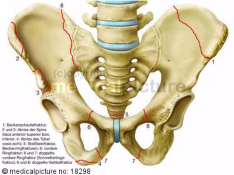 Lower Extremity Pelvic Fractures Acetabular Fractures