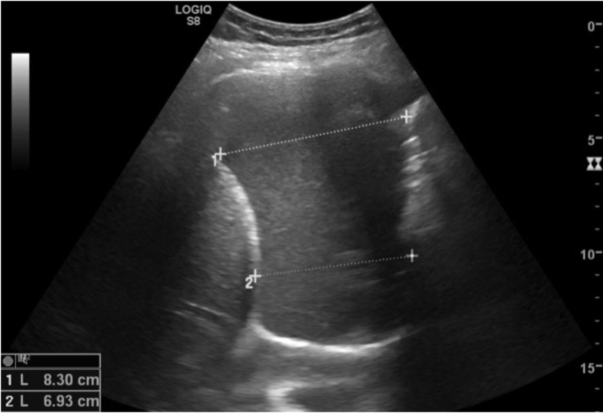 Thoraxsonographie (Pleuraerguss)