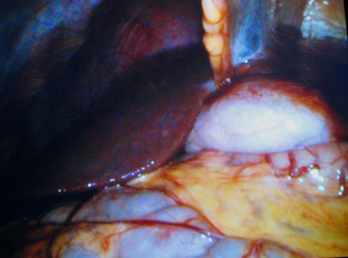 Gallenblase im linken Leberlappen (Rarität)