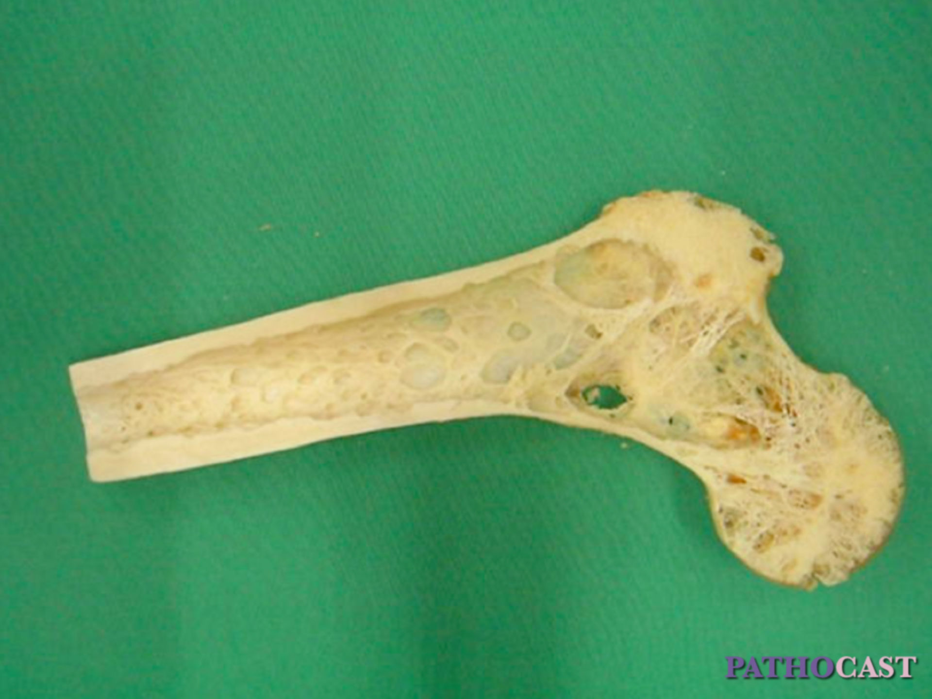 Osteoporosis of proximal femur