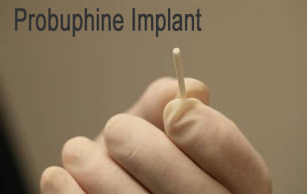 propuphine-implantAT