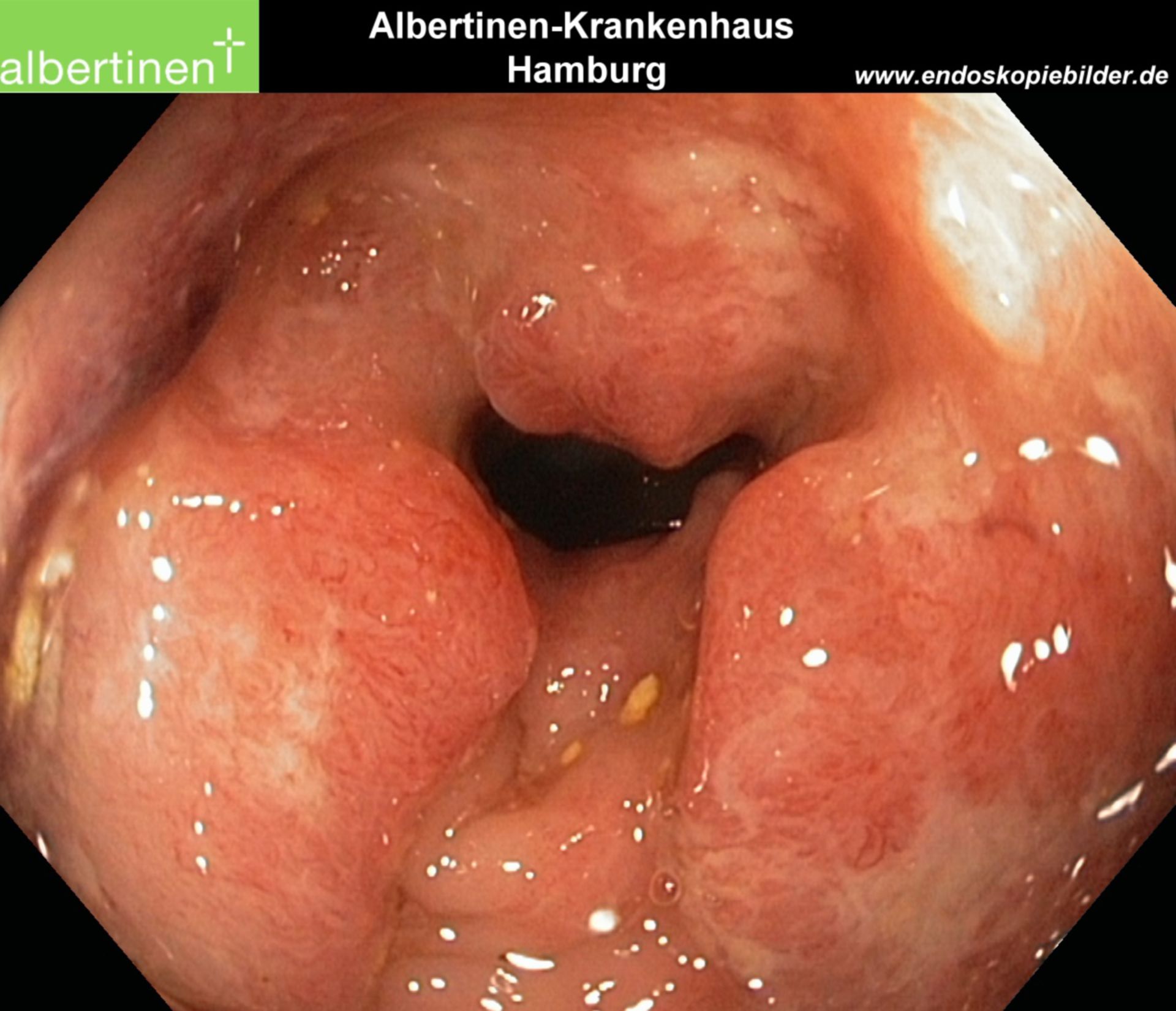 Colon-carcinom circulär Endo