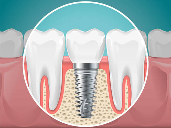 pros_and_cons_of_dental_implants_original.jpg