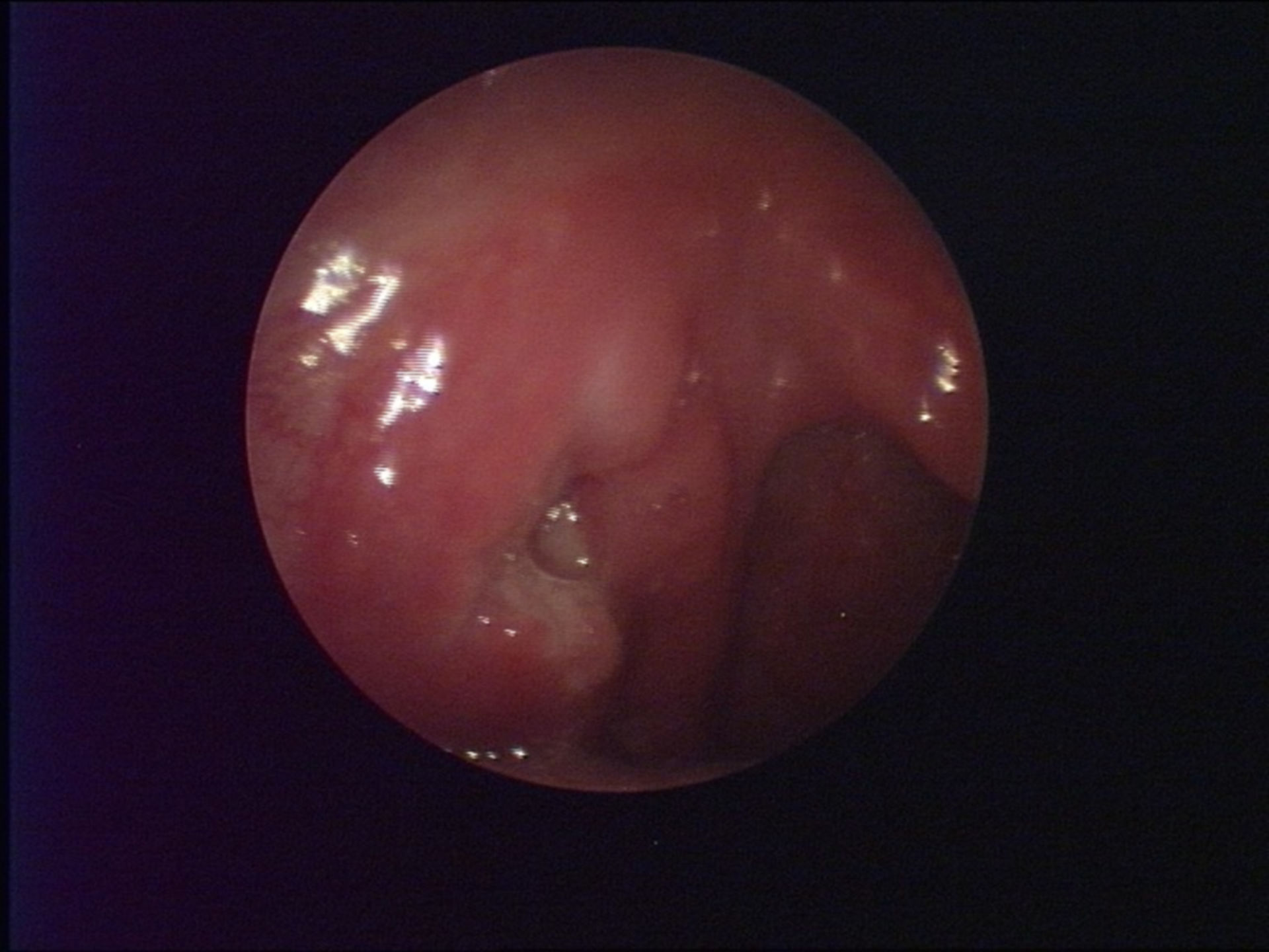 Tonsil ulcer in syphilis