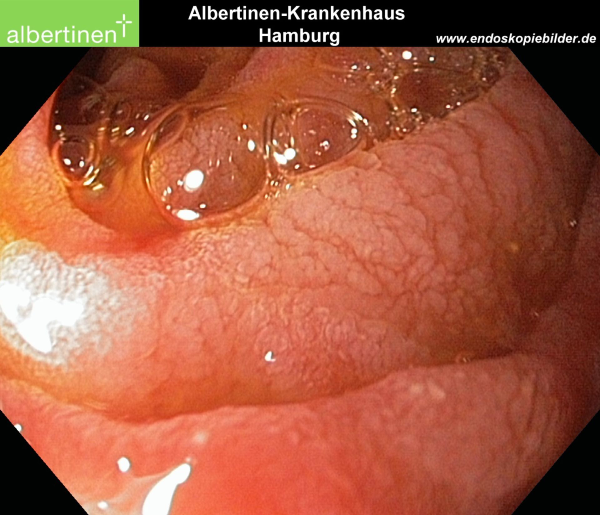 Zottenatrophie Duodenum Endo