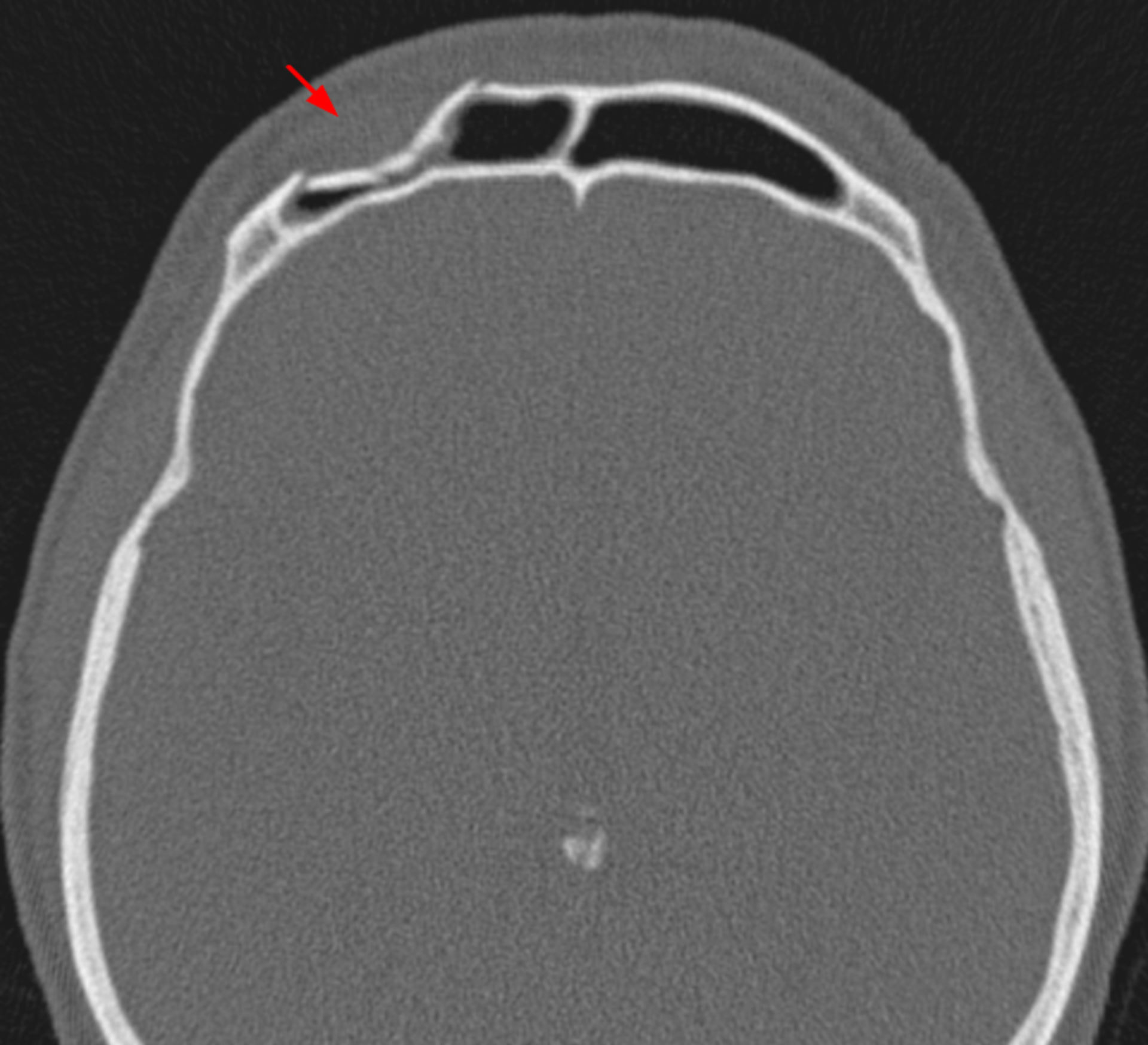 Fracture of the frontal sinus (CT, axial)