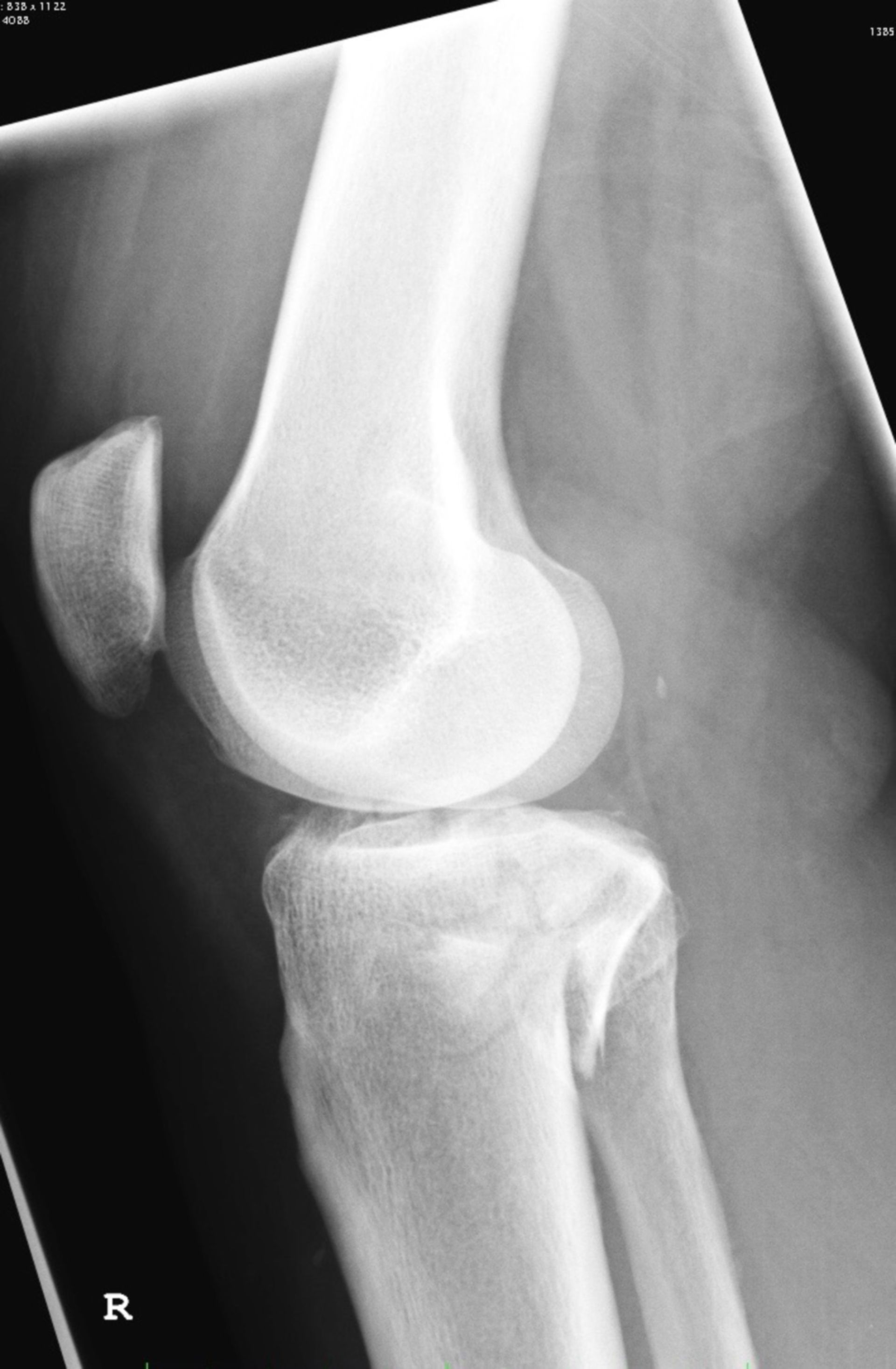 Röntgen des Kniegelenkes von lateral und es zeigt sich eine Tibiakopffraktur