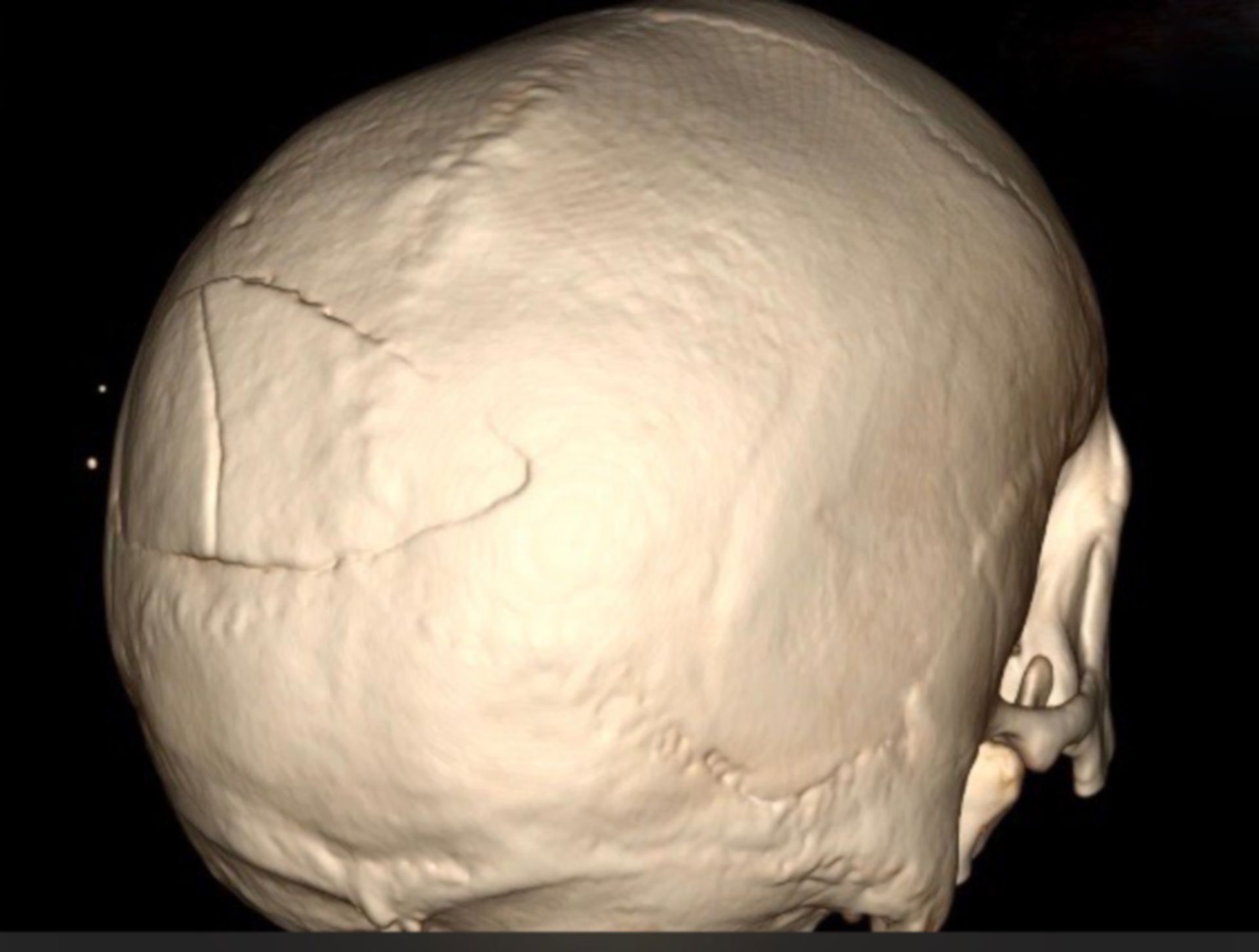 3-D Rekonstruktion des knöchernen Schädels in der Ansicht von dorsal.