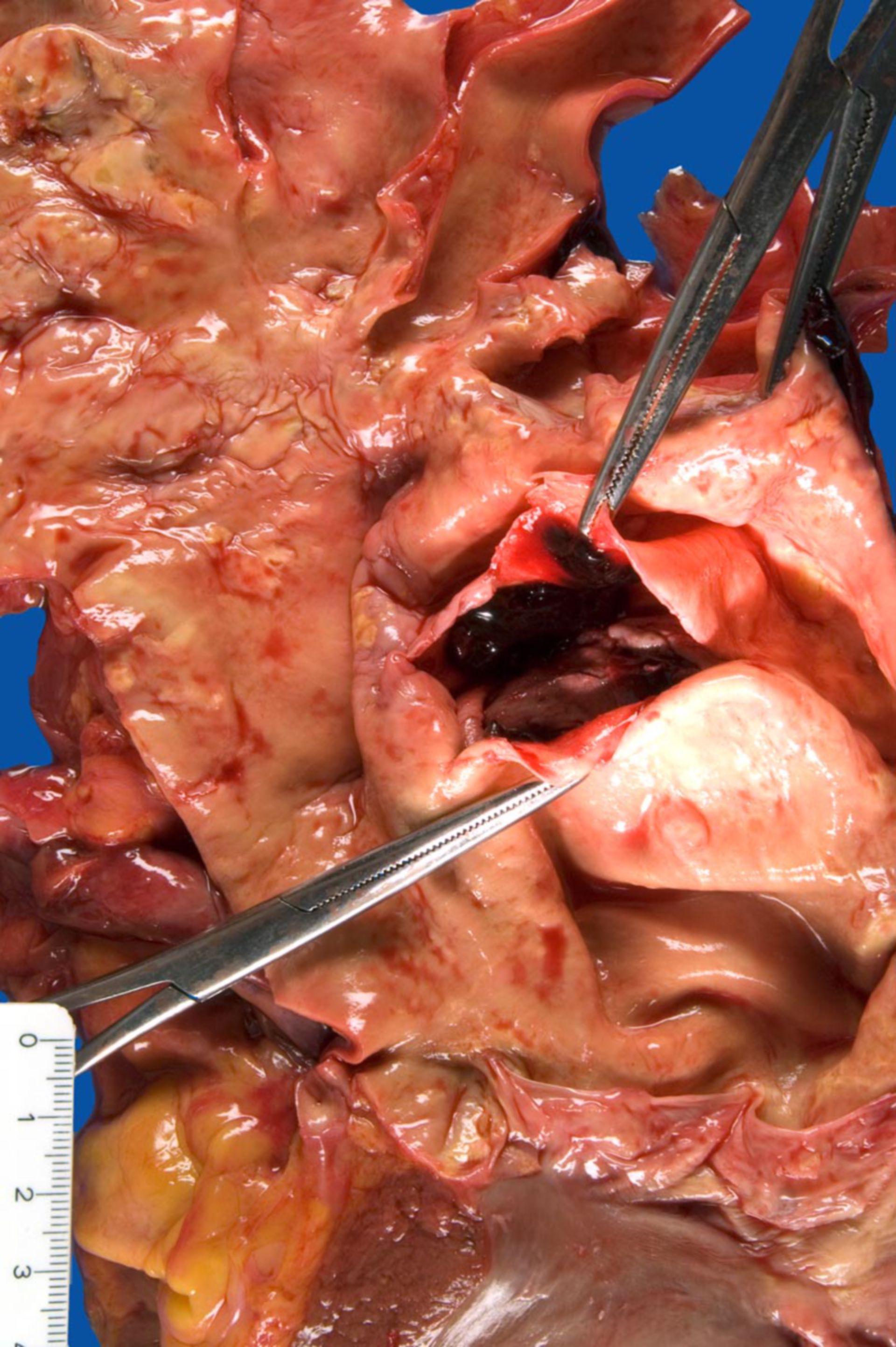 Acute rupture of a dissecting aneurysm of the aorta