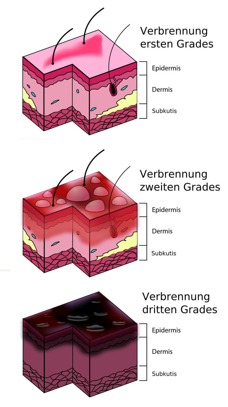 800px-burn_degree_diagram-de_original.jpg