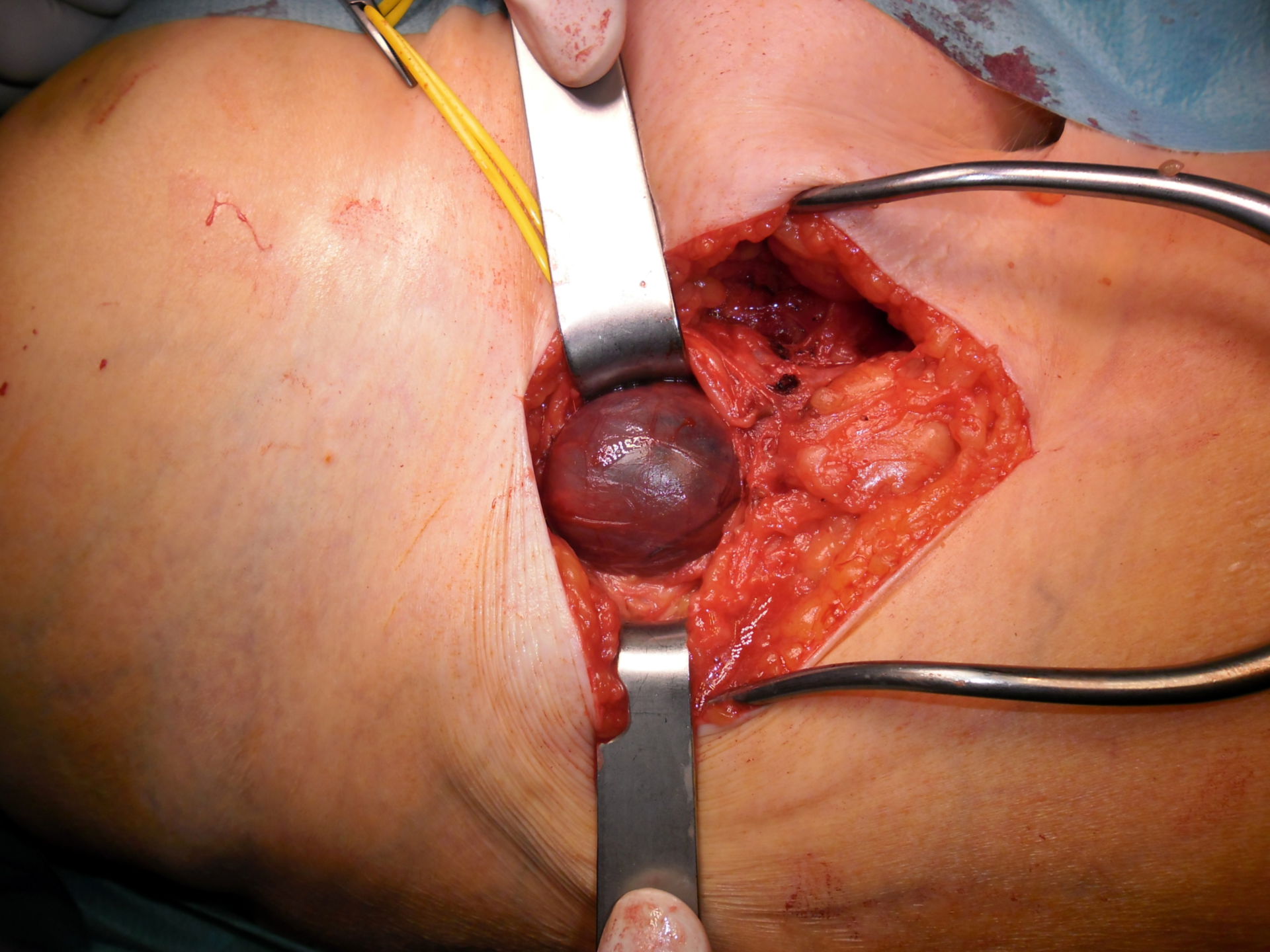 Synovialitis due to titanium abrasions of the acetabulum after TEP of the right hip
