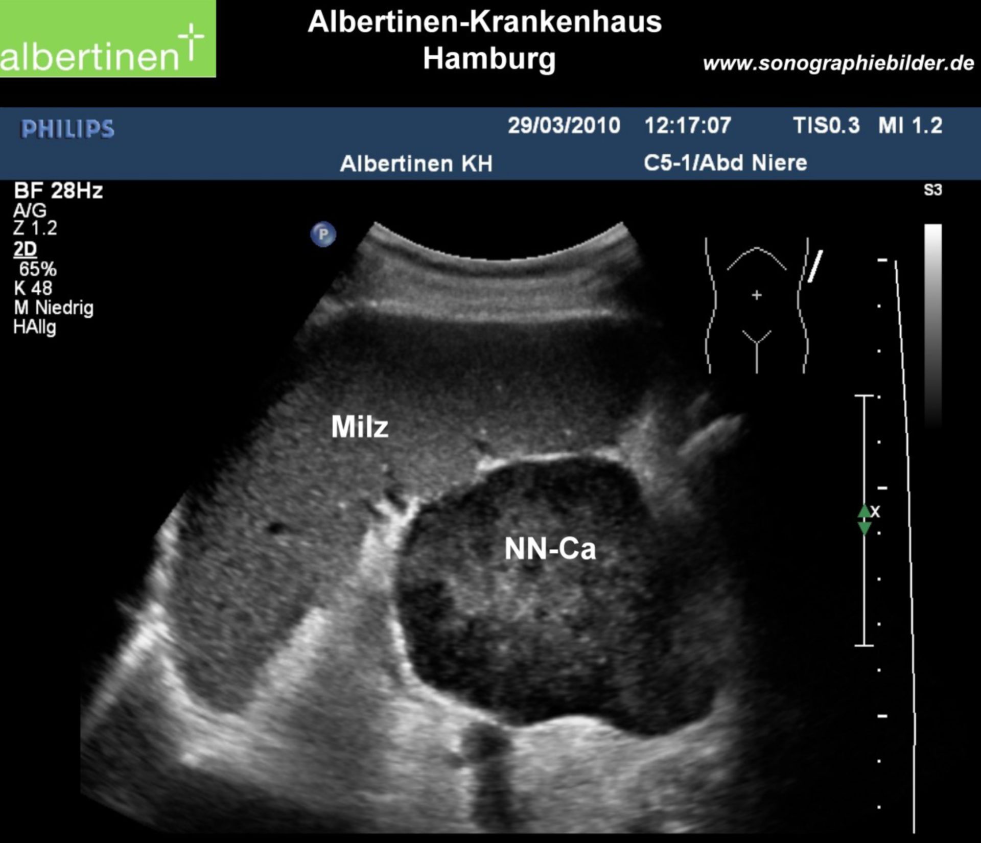 Adrenal gland carcinoma