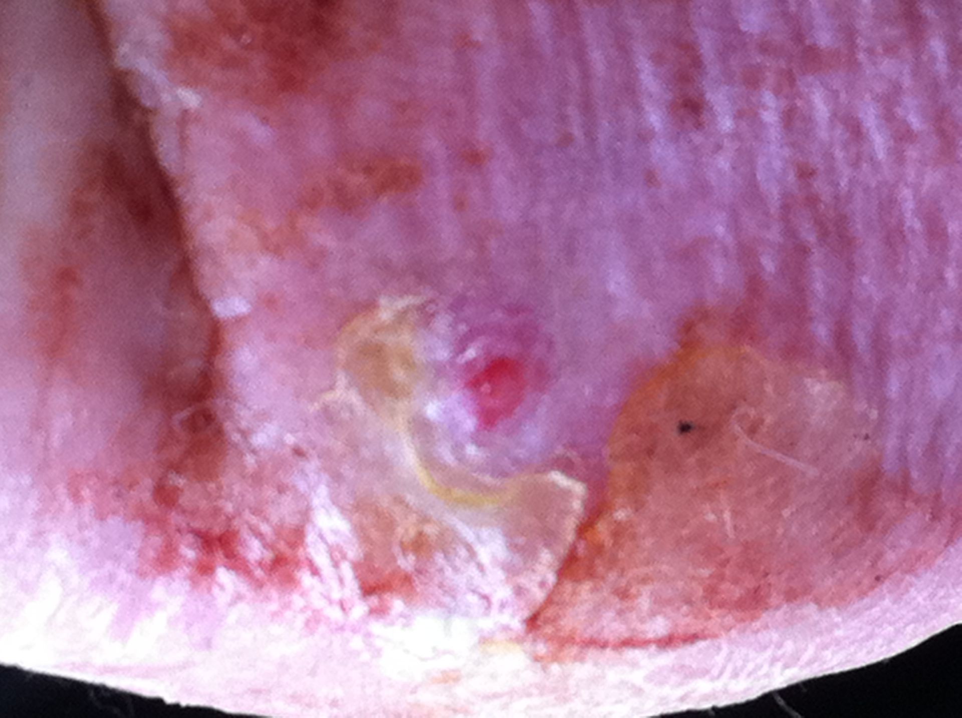 Dermatology, injury wound on the foot