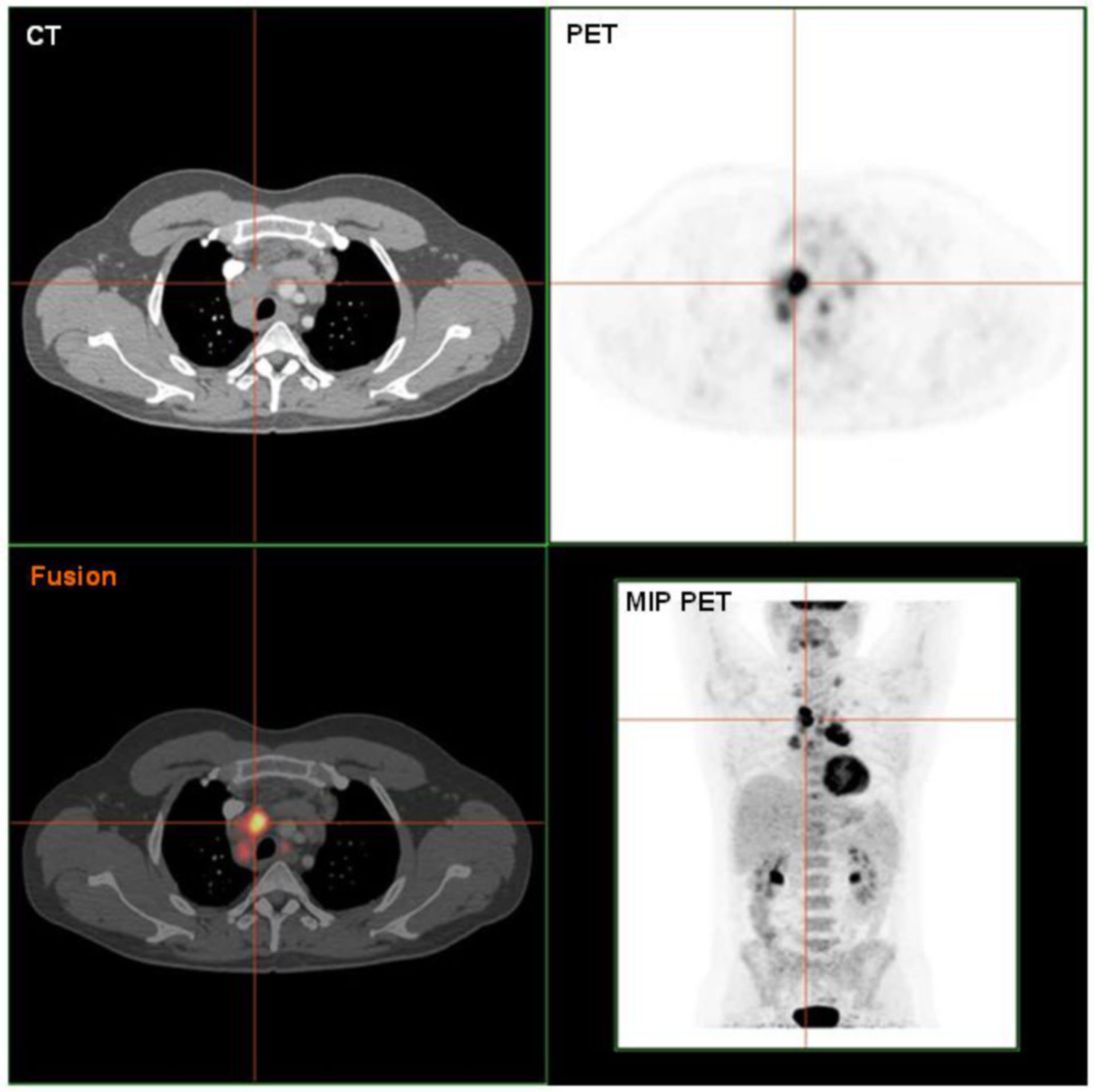 PET CT Scan Of A Hodgkin Lymphoma Histologically Validated DocCheck