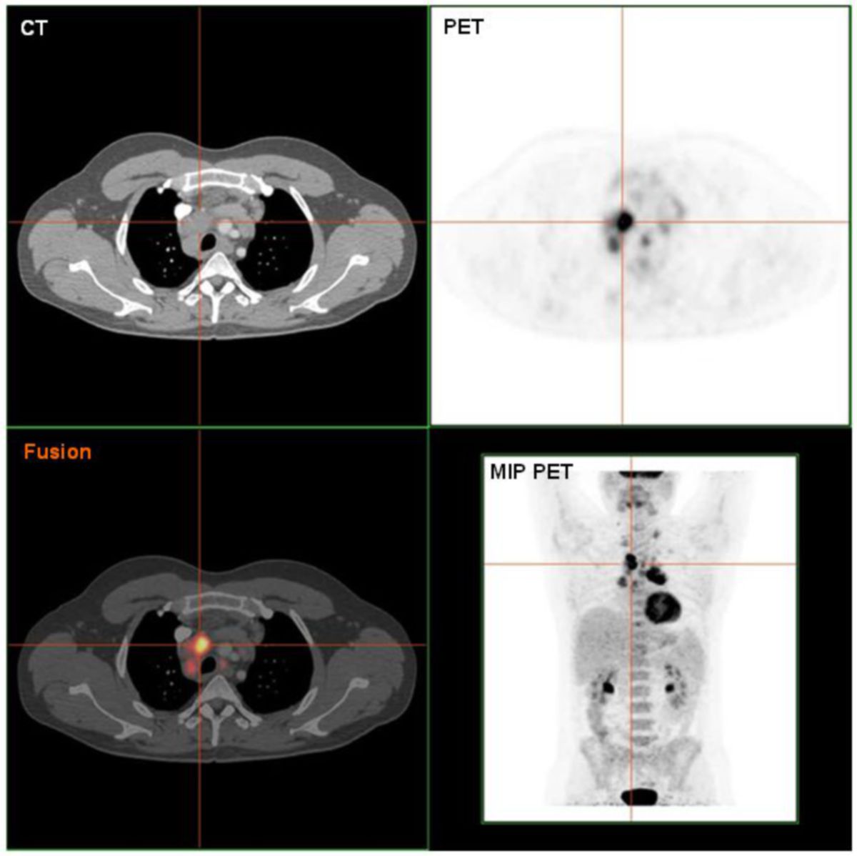 PET/CT-Aufnahme eines Hodgkin Lymphoms (histologisch gesichert)