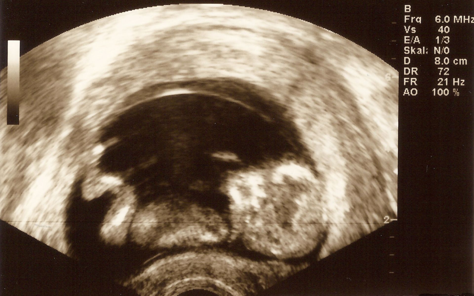 12 semanas de embarazo - ultrasonido
