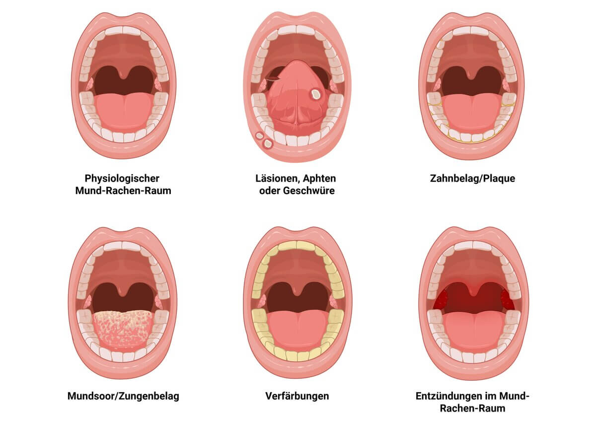Mögliche Befunde der pflegerischen Mundinspektion