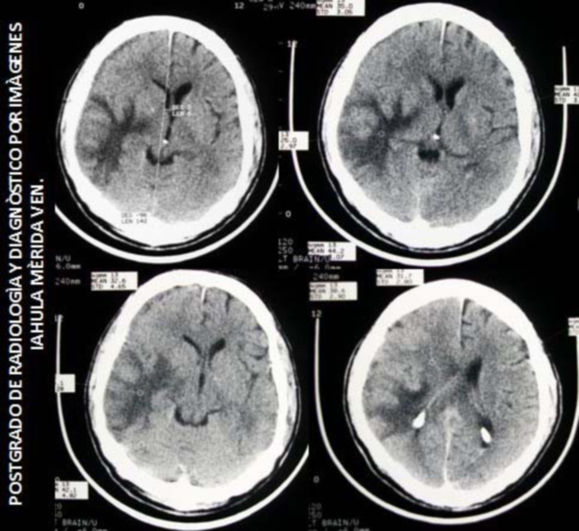 Brain hematoma