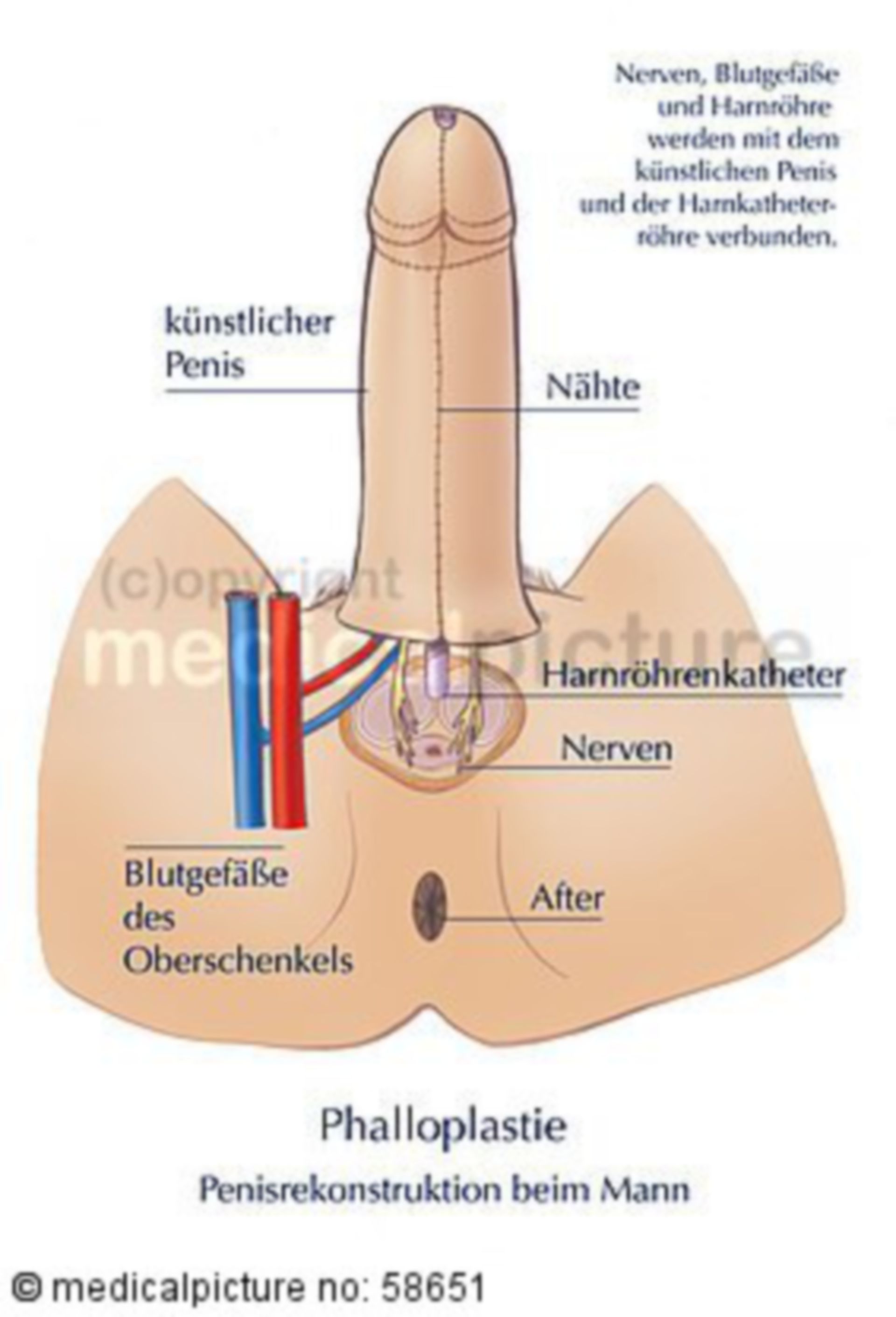 Penis-(re)construction (attachment to male anatomy, labelled)